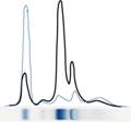 Nefrotick� syndrom